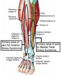 The term shin splints refers to pain along the shin bone (tibia) — the large bone in the front of your lower leg. Tibial Stress Syndrome Shin Splints Knee Sports Orthobullets