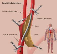 The plaque buildup is made of fat, cholesterol, cellular waste, calcium, proteins and inflammatory cells. Medical Treatments For Carotid Artery Disease Stanford Health Care