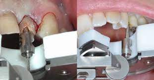 But if you do need to remove a tooth, it could be for a variety of reasons: This New Dental Tool Is The Solution To All The Painful Tooth Extractions