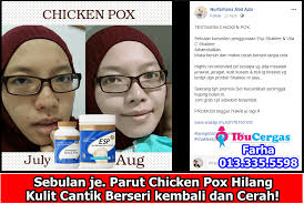 Kalau boleh nak kulit kembali sihat dan cantik sebelum terkena jerawat. Pin Di Ubat Hilangkan Parut Chicken Pox