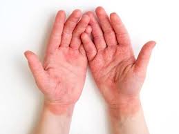 Some of them, like the newly discovered symptom of itchiness, can be easy to miss and to overlook. Long Covid All You Need To Know About Covid Toes The Mysterious Symptom Which Could Last For Upto Six Months The Times Of India