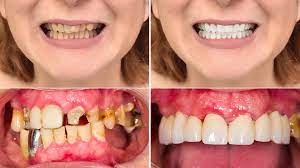 How To Make Your Teeth Look Better Smile Angels Of Beverly Hills