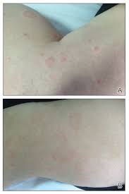 Image result for Papular urticaria