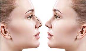 Atunci cand pacientul este diagnosticat cu deviatie de sept, doreste sa isi rezolve aceasta afectiune si in acelasi timp este multumit de aspectul estetic al nasului sau. Septoplastie Vs Rinoplastie Deviatie De Sept Operatie De Deviatie De Sept Rinoplastie Operatie De Rinoplastie Operatie Estetica La Nas Remodelare Nas