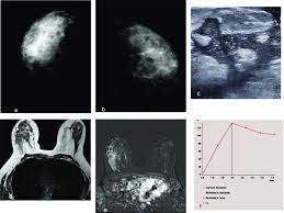 The appearance of normal breast tissue on a mammogram. A F Inflammatory Breast Cancer 35 Years Old Female Patient With Download Scientific Diagram