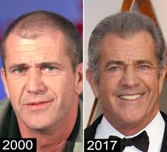 Did steve carell get a hair transplant. Steve Carell Marca English