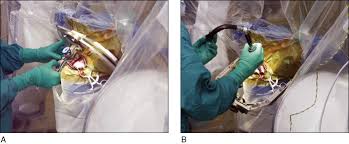 Image result for Thalamotomy