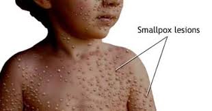 هل الإصابة بالجدرى المائى يسبب مناعة مدى الحياة اليوم السابع