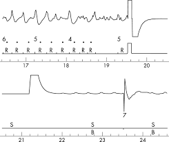 Manual defibrillation with the heartstart intrepid discover the difference between cardioversion and defibrillation and how to shock someone back to life. Hazards Of Performing Chest Compressions In Collapsed Patients With Internal Cardioverter Defibrillators Emergency Medicine Journal