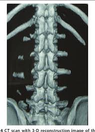A fracture of a transverse processis a break of a part of one of the bones in the spine. Multiple Lumbar Transverse Process Stress Fractures As A Cause Of Chronic Low Back Ache In A Young Fast Bowler A Case Report Semantic Scholar