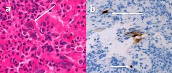 Differential diagnosis between herpes simplex virus (hsv) esophagitis and cytomegalovirus (cmv) esophagitis is challenging because there are many similarities and overlaps between their. A Case Of Cytomegalovirus Esophagitis During Topical Steroid Therapy For Eosinophilic Esophagitis Springerlink