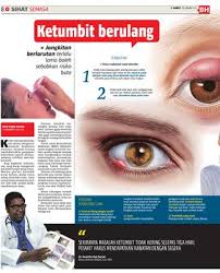 Ketumbit adalah keradangan kelenjar pada kelopak mata atau pada akar bulu mata. Ketumbit Berulang Klik