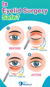 eyelid surgery get rid of undereye bags eyelid surgery best hospitals surgery