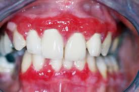 Image result for Pemphigoid