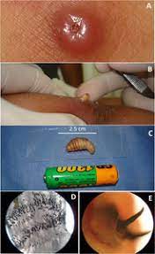 Local treatment of human botfly myiasis in belize. Human Botfly Infestation In An Amerindian Girl In Southern Venezuela In The American Journal Of Tropical Medicine And Hygiene Volume 104 Issue 4 2021