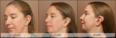 Mary Kay Clear Proof Acne System Review 10 Day And 30 Day Results