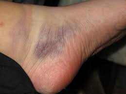 Nekoliko kockica leda zamotajte u peškir i prislonite na otečeno mesto. Masnica Na Nozi