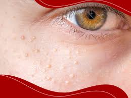 Image result for xantelasma