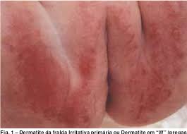 Image result for diaper dermatitis adult -children -infant -baby