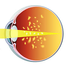 I still have floaters that the doc says is from the hemorrhage that should go away in time. Eye Floaters In The Vitreous A Guide By Natural Eye Care
