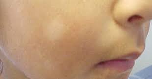 The patches are dry with very fine scales. Pityriasis Alba White Spots On Face Of Child Key To Perfect Health