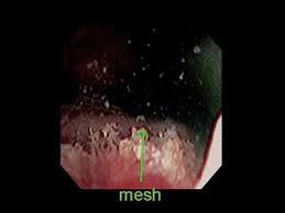 Intravesical Midurethral Sling Mesh Erosion Secondary To Transvaginal Mesh Reconstructive Surgery Sciencedirect