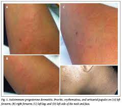 Autoimmune Progesterone Dermatitis Case Report With History Of Urticaria Petechiae And Palpable Pinpoint Purpura Triggered By Medical Abortion