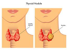 However, thyroid cancers generally begin with a nodule and 1 to 2 percent of nodules may be cancerous, so if you have a thyroid nodule, it's important to get an accurate diagnosis. Thyroid Nodules Prevalence Symptoms Causes Diagnosis And Treatments