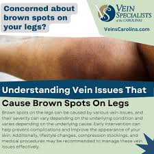 Image result for liver spots on legs