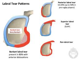Image Result For Superior Glenoid Labrum Lesion Images Tears Rotator Cuff Dislocation