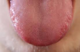 Beberapa faktor yang dapat memicu vitiligo, yaitu kondisi autoimun, paparan sinar matahari yang berlebihan, bahan kimia tertentu, atau stres. Efek Samping Vaksin Covid 19 Waspadai Bercak Putih Pada Lidah Himedik Com