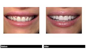 Perfect Porcelain Veneer Tooth Shapes For Your New Smile