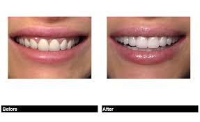 perfect porcelain veneer tooth shapes for your new smile