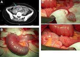 There are two parallel muscles, separated by a midline band of connective tissue called the linea alba. Sausage Like Mass In Lower Abdomen Gastroenterology