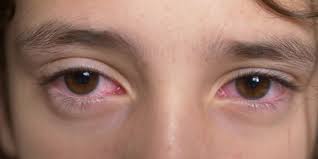 Augenbrennen kann auch mit augenjucken verbunden sein. Rote Augen Beim Kind Mogliche Ursachen Und Behandlungsmoglichkeiten