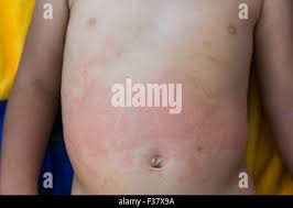 Sarpullido De La Alergia En La Torse De Un Bebe De 2 Anos Fotografia De Stock Alamy