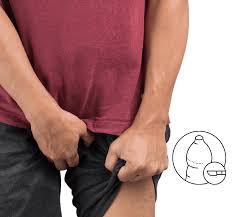 Image result for Phimosis