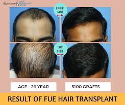 Yet another reason for hair loss at a young age is the hormonal changes when a body goes from teenage to adolescent. How To Get Good Result Of Hair Transplant At A Young Age Hair Transplant Best Hair Transplant Help Hair Loss