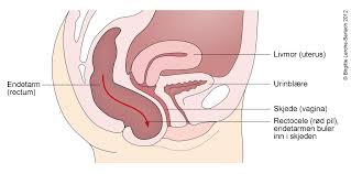 Grunnet en høy forekomst av underlivsprolaps (prolaps/nedfall/fremfall av blære, livmor og/eller tarm) blant kvinner og tilhørende problemer er det et stort behov for å identifisere risikofaktorer, forebygging. Livmor Nedsunken Oversikt Nhi No