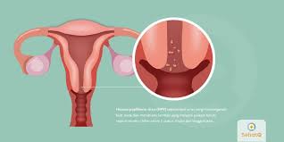 Hpv infection is a viral infection that commonly causes skin or mucous membrane growths (warts). Hpv Tanda Dan Gejala Penyebab Cara Mengobati Cara Mencegah