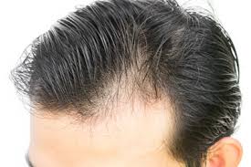 Hair transplants aren't common treatments for female pattern baldness because of the way hair loss usually presents itself in women: How Light Can Cure Baldness
