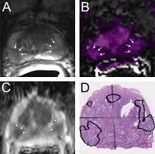 Stage 1 the tumour is contained in the prostate. Multifocality And Prostate Cancer Detection By Multiparametric Magnetic Resonance Imaging Correlation With Whole Mount Histopathology European Urology