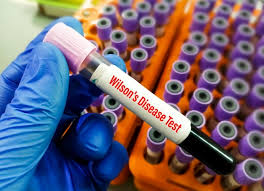 Image result for Wilson Test