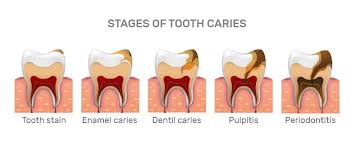 Fluoride fluoride is one of the best defenses you and your kids have against early tooth decay. How To Prevent Tooth Decay In Toddlers Mga Dental