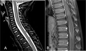 The inflammation interrupts the signals between the brain, the nerves along the impacted. Acute Transverse Myelitis Following An Opsoclonus Myoclonus Syndrome An Unusual Presentation European Journal Of Paediatric Neurology