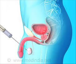 Biopsy ( plural biopsies ) the removal and examination of a sample of tissue, cells, or bodily fluid from a living body for diagnostic purposes. Testicular Biopsy Types Procedure Precautions Risks Results