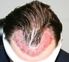 Neograft is a type of fue hair replacement therapy used by our los angeles surgeons that creates healthy hair grafts by gently removing hair. The Importance Of Direction And Angling In Hair Transplantation