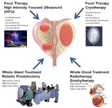 Find out the signs and symptoms of prostate cancer from cancer research uk. Prostate Cancer An Overview Of Surgical Treatments Prostate Matters