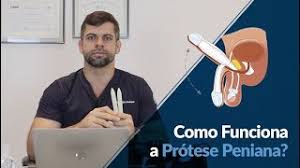 Como Funciona A Protese Peniana Dr Marco Tulio Cavalcanti Youtube