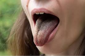 Image result for black hairy tongue symptoms